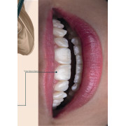 Elóra APS - сучасний наногібридний композит з унікальними можливостями Elóra APS - сучасний наногібридний композит з унікальними можливостями