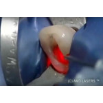 Відео: Дезінфекція кореневого каналу лазером PICASSO Відео: Дезінфекція кореневого каналу лазером PICASSO