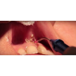 Відео: Стоматологічний лазер PICASSO - френулотомія Відео: Стоматологічний лазер PICASSO - френулотомія