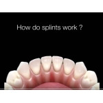 Відео: How Do Dental Splints Work  Відео: How Do Dental Splints Work