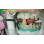 Відео: Лазерне відбілювання зубів Відео: Лазерне відбілювання зубів