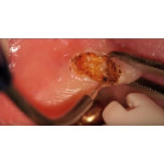 Відео: Стоматологічний лазер PICASSO Lite - оперкулектомія Відео: Стоматологічний лазер PICASSO Lite - оперкулектомія