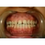 Відео: Корекція ясна стоматологічним лазером PICASSO Відео: Корекція ясна стоматологічним лазером PICASSO