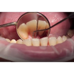 Відео: Стоматологічний лазер Picasso і пародонтологія Відео: Стоматологічний лазер Picasso і пародонтологія