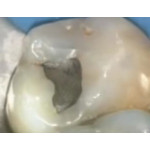 Відео: Стоматологічний лазер PICASSO - стерилізація пульпи Відео: Стоматологічний лазер PICASSO - стерилізація пульпи