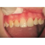 Відео: Стоматологічний лазер PICASSO - після орто лікування Відео: Стоматологічний лазер PICASSO - після орто лікування