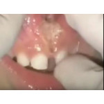 Відео: Стоматологічний лазер PICASSO - френектомія вуздечки Відео: Стоматологічний лазер PICASSO - френектомія вуздечки