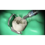 Відео: Обтурація кореневих каналів Відео: Обтурація кореневих каналів