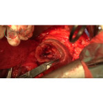 Відео: Відкрита резекція нирки із застосуванням шовного матеріалу ERGON EST  Відео: Відкрита резекція нирки із застосуванням шовного матеріалу ERGON EST