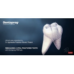 Відео: Відновлення зламаного зуба за допомогою парапульпарних штифтів Відео: Відновлення зламаного зуба за допомогою парапульпарних штифтів