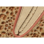 Відео: Endo Vac Відео: Endo Vac