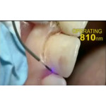 Відео: Наочна відмінність в роботі доданим лазером Picasso-810 nm і іншим лазером - 940,980 nm Відео: Наочна відмінність в роботі доданим лазером Picasso-810 nm і іншим лазером - 940,980 nm