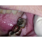 Відео: Стоматологічний лазер PICASSO - пластика ясна під коронку Відео: Стоматологічний лазер PICASSO - пластика ясна під коронку