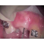 Відео: Видалення ясна стоматологічним лазером PICASSO Відео: Видалення ясна стоматологічним лазером PICASSO