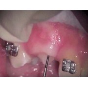 Видео: Удаление десны стоматологическим лазером PICASSO 