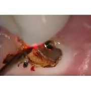 Видео: Вскрытие импланта стоматологическим лазером Picasso 
