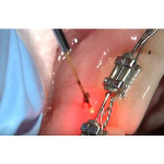 Відео: Використання діодного лазера при гінгівектомії навколо дужок  Відео: Використання діодного лазера при гінгівектомії навколо дужок