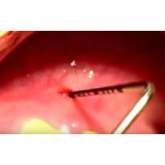 Відео: Робота ербіевого лазера на м'яких тканинах. 1 Відео: Робота ербіевого лазера на м'яких тканинах. 1