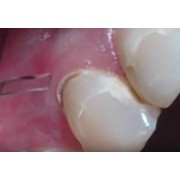 Відео: Робота ербіевого лазера на зубних тканинах 4