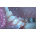 Відео: Робота на пацієнтах VersaWave Відео: Робота на пацієнтах VersaWave