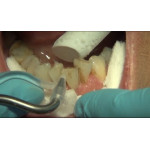 Відео: Клінічна чистка зубів за допомогою соди Sylc Відео: Клінічна чистка зубів за допомогою соди Sylc