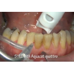 Відео: Полірування зубів содою Sylc Відео: Полірування зубів содою Sylc