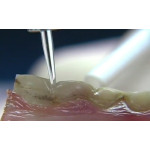 Відео: Лазер VersaWave Відео: Лазер VersaWave