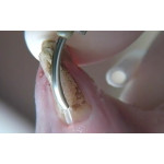 Відео: Erbium VersaWave  Відео: Erbium VersaWave