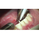 Відео: Лазер серії VersaWave Відео: Лазер серії VersaWave