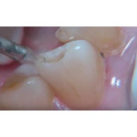 Відео: Застосування ербевого лазера VersaWave Відео: Застосування ербевого лазера VersaWave