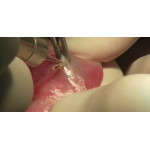 Відео: Клінічне застосування лазера VersaWave Відео: Клінічне застосування лазера VersaWave