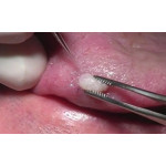 Відео: Використання лазера VersaWave Відео: Використання лазера VersaWave