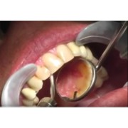 Відео: Робота ербіевого лазера на зубних тканинах. 2